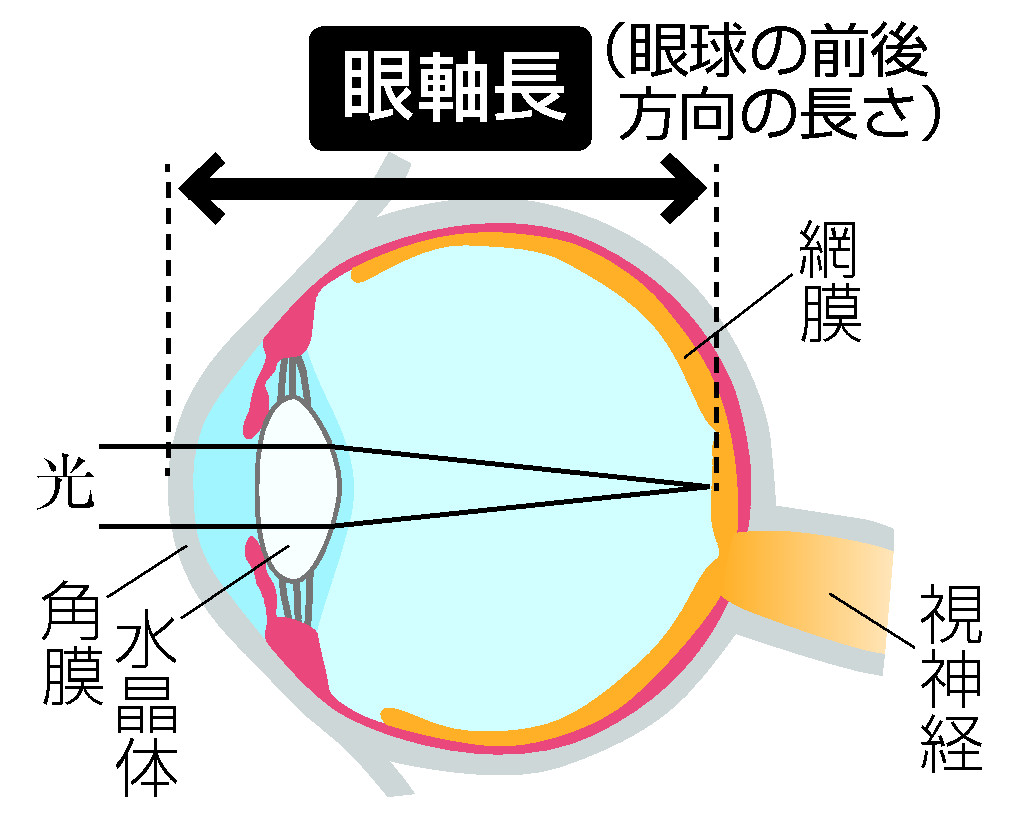 眼軸長