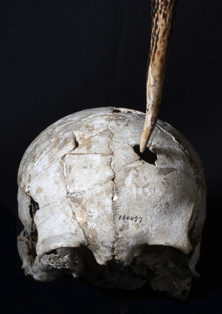 とがった道具で刺された形跡が見つかった縄文人骨と、刺すのに使ったと想定される鹿の角（東京大総合研究博物館提供）